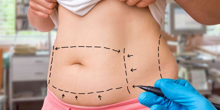 Expect Before The Liposuction Cosmetic Surgery