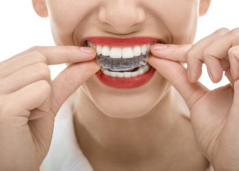 The Early History of Braces