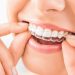 How Do Orthodontists Help You Restore Your Smile?