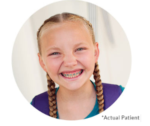 Things you should know about braces