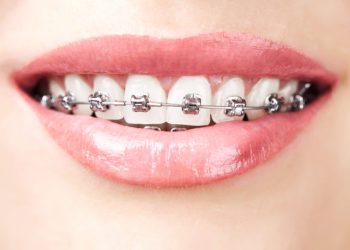 Affordable Orthodontic Care in Clemson