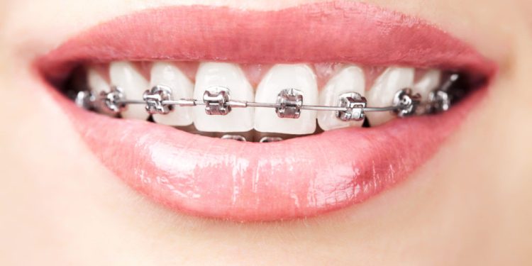 Affordable Orthodontic Care in Clemson