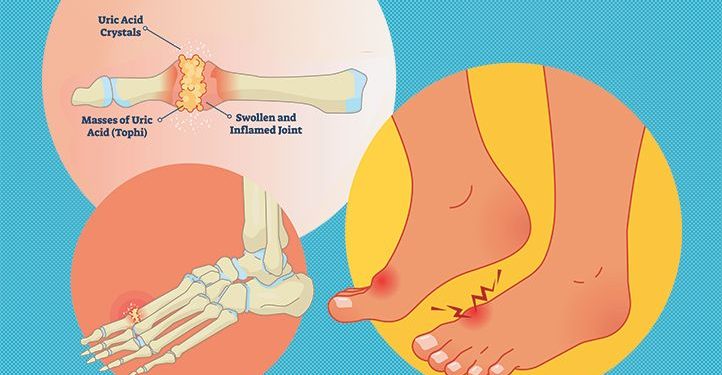 Gout Prevention and Treatment