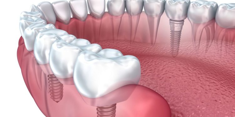 How to Find Cost-Effective Dental Implants