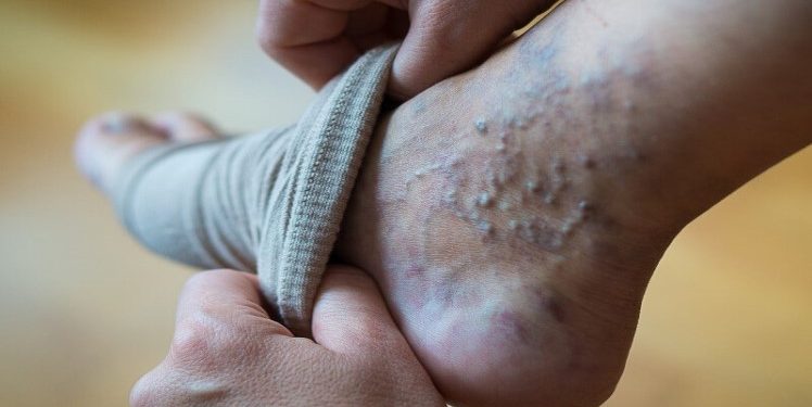 Top 6 Home Remedies for Varicose Veins