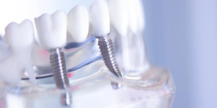Things You Need to Know About Dental Implants in Miami