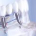 Things You Need to Know About Dental Implants in Miami