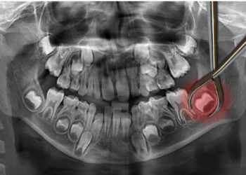 The wisdom behind wisdom teeth