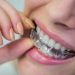Invisalign London for older adults