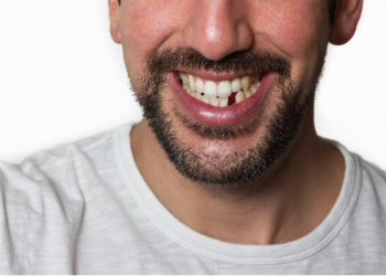 Replacing missing teeth with dental implants Sydney CBD