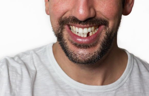 Replacing missing teeth with dental implants Sydney CBD