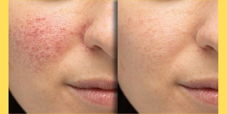 What To Expect During A Diamond Glow Facial