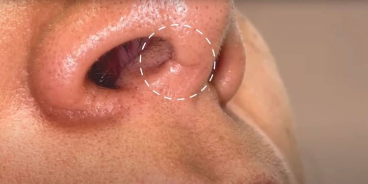 What Causes Scars After Nose Job Surgery