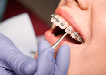 Everything You Need to Know About Braces in London