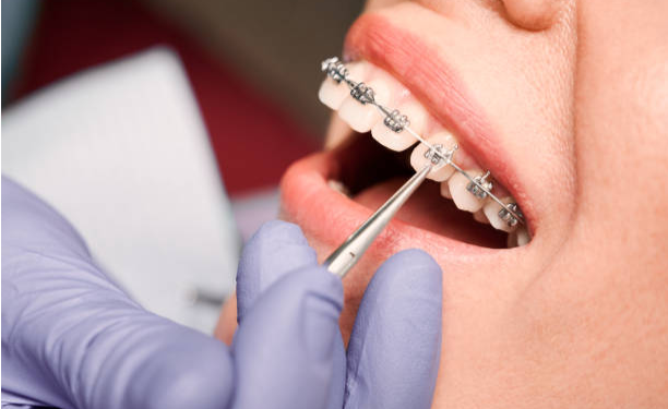 Everything You Need to Know About Braces in London