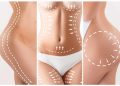 Considering a Mommy Makeover? Here Are the Procedures You May Undergo